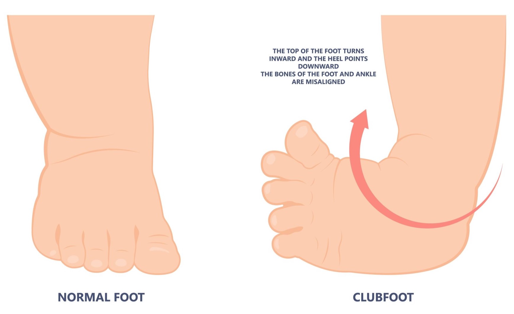 Club foot